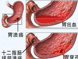 十二指肠溃疡