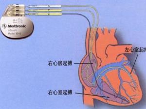 心脏起搏器