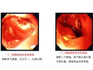 十二指肠溃疡