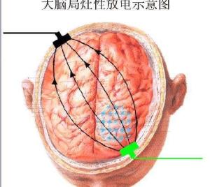 癫痫