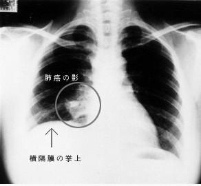 肺癌的临床表现