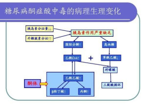 糖尿病酮症酸中毒