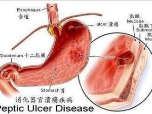十二指肠溃疡