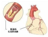 心脏支架