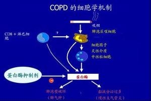 慢性支气管炎