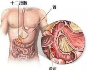 十二指肠溃疡