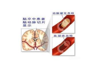 脑血栓
