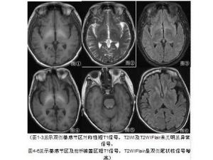 肝性脑病