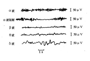 脑电图