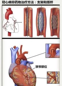 冠脉支架