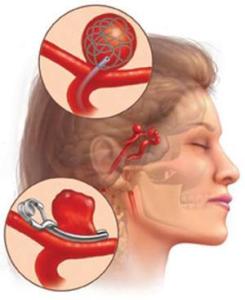 颅内动脉瘤
