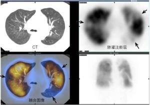 肺栓塞治疗