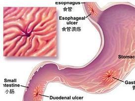 十二指肠溃疡
