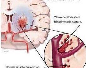 出血性中风